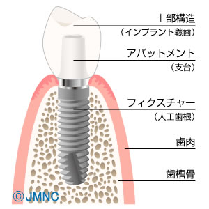 インプラントイメージ2