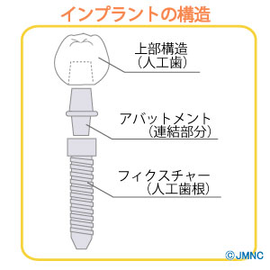 インプラントイメージ1