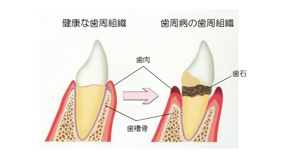 歯周病画像4